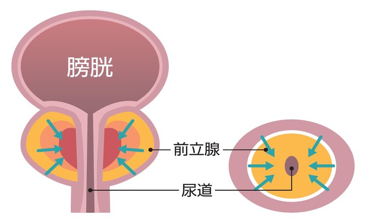 前立腺肥大症イメージ画像