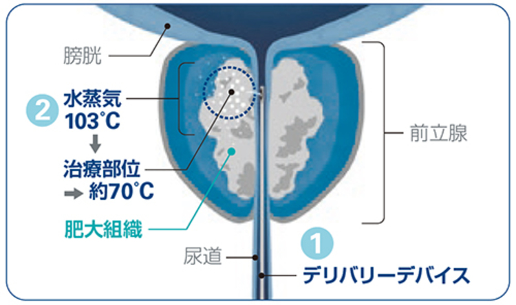 デリバリーデバイスの先端から針が出る様子