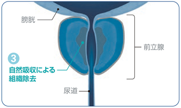 水蒸気が前立腺組織に充満する様子